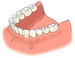 Posterior Implants