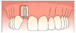 single tooth implant