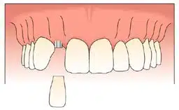 single tooth implant